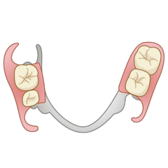 一番奥の歯が無い場合、入れ歯の支えを反対側の歯に求めるため、イラストのような大きな入れ歯になってしまい、違和感が出やすくなります。