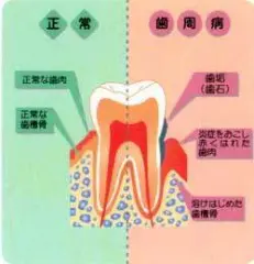 卸売 歯牙移動による歯周組織再生療法 : 包括的歯科治療のなかでどう 