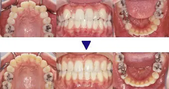 床矯正治療について | 佐野市の歯医者 よこづか歯科医院