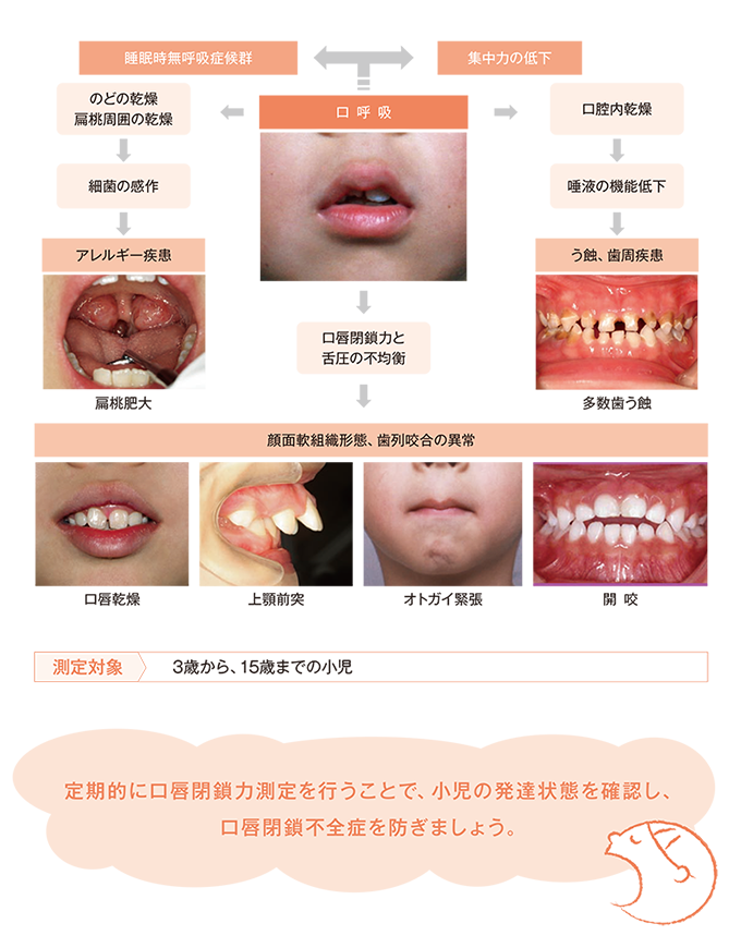 ポカン口（口唇閉鎖不全症） 佐野市の歯医者 よこづか歯科医院